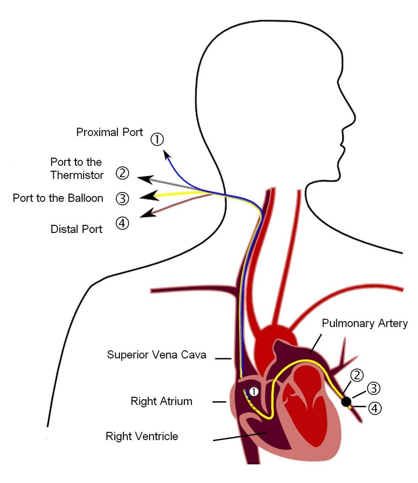 Arteria pulmonar