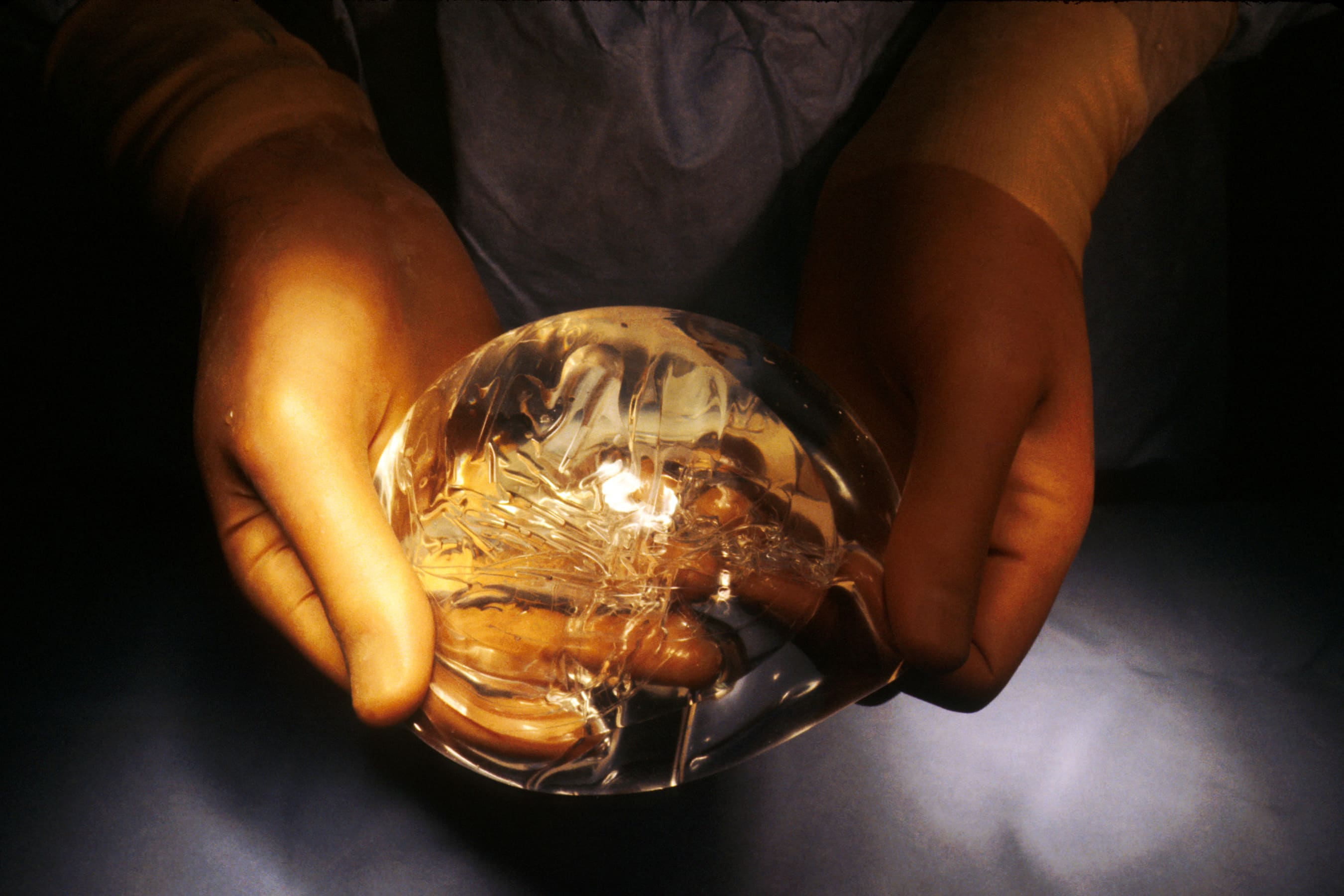 Dow Corning Breast Implant Lawsuits