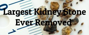 largest-kidney-stones