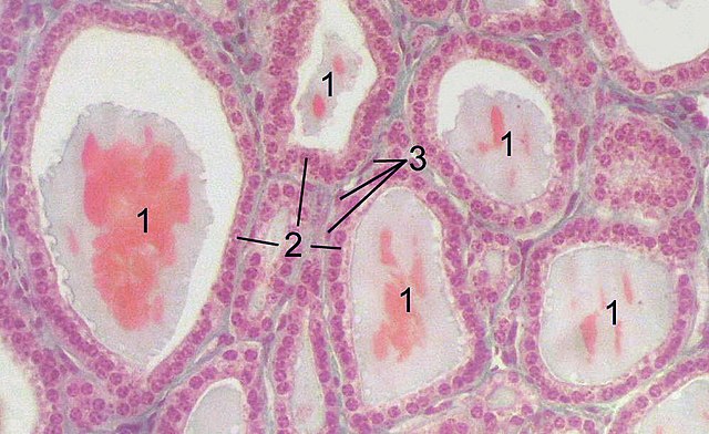 Pseudopseudohypoparathyroidism