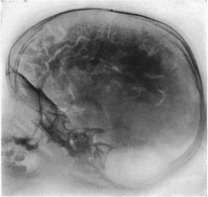 Pneumoencephalographically